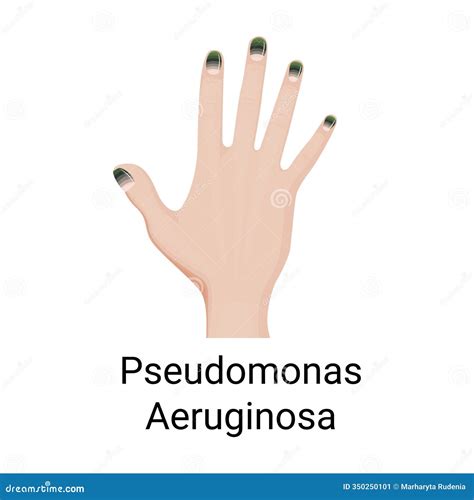 Green Nail Syndrome, Toenail Chloronychia Cartoon Vector ...