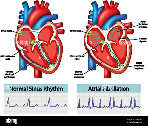 Detailed vector illustration comparing normal sinus rhythm and atrial ...