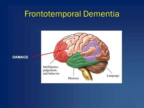 Frontotemporal dementia - A comprehensive guide