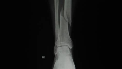 Compound Fracture X Ray