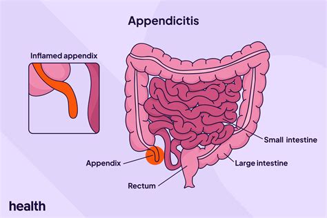 Image result for Different Types of Appendicitis