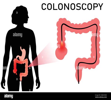 Image result for Colonoscopy Image System Component