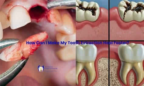 Image result for Healed Tooth Extraction
