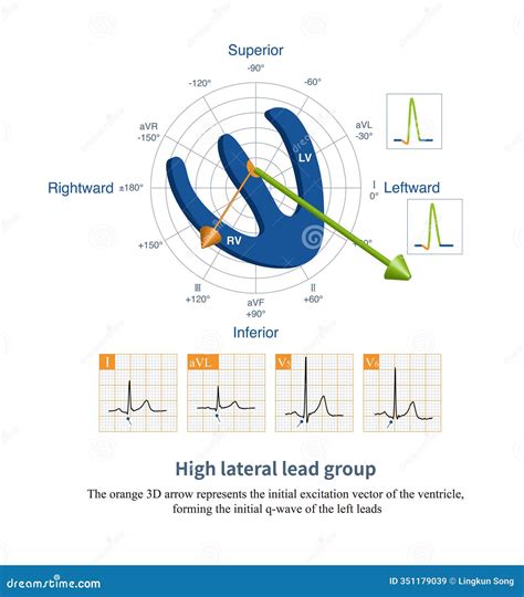 High lateral lead group stock illustration. Illustration of electrocardiograph - 351179039 - lateral leads of ecg