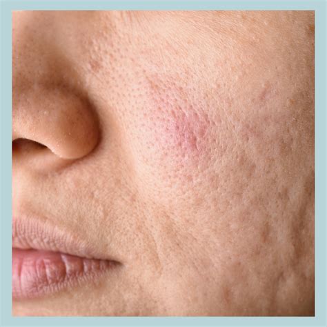 How to Manage Large Pores: Causes, Treatments & Daily Tips – RESART ...
