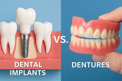 Denture Dental Implants