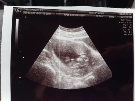 11 Week Ultrasound Pictures