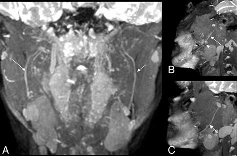 Trigeminal Nerve Mri Protocol MR Scan Of The Trigeminal Nerve And