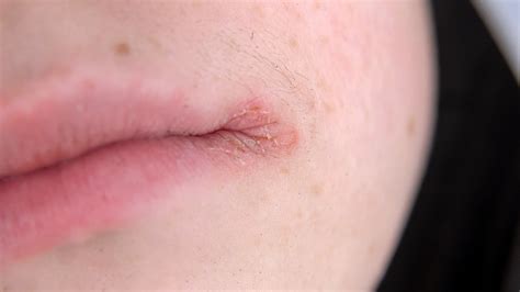 Lip Eczema: Causes and Treatments - GoodRx