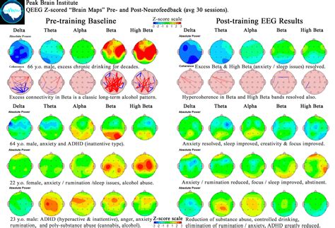 Image result for MATLAB Qeeg Brain Map