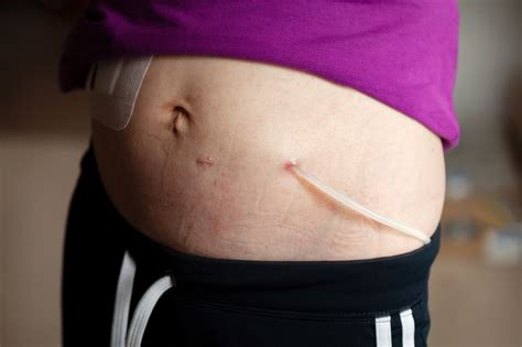 Dialysis Catheter Types