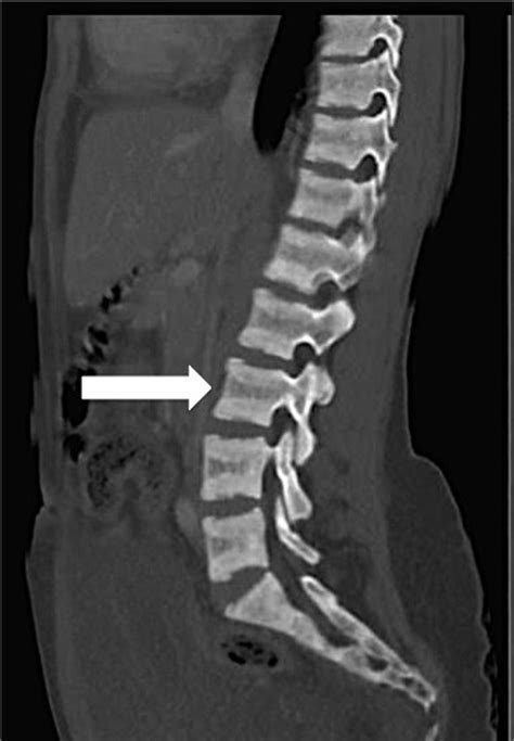 The rugger-jersey spine - Kidney International