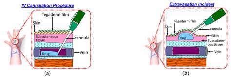 Novel Conformal Skin Patch with Embedded Thin-Film Electrodes for Early ...