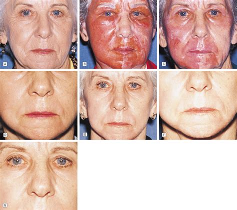 Collection 100+ Pictures Deep Chemical Peel Before And After Photos Completed