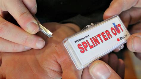 Image result for How to Get an Embedded Splinter Out