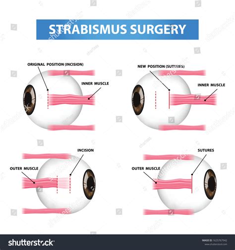 Cross Eye Surgery
