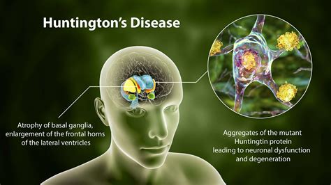 Huntington’s disease progression stopped in cell study by University of Cambridge and UCL ...