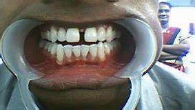 Cosmetic Dental Treatment in Trichy