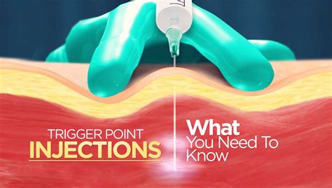 Trigger Point Injections 的图像结果