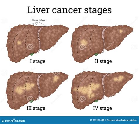 Stages Of Liver Cancer