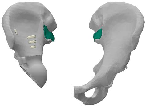 Acetabular Implant Finite Element Simulation with Customised Estimate ...