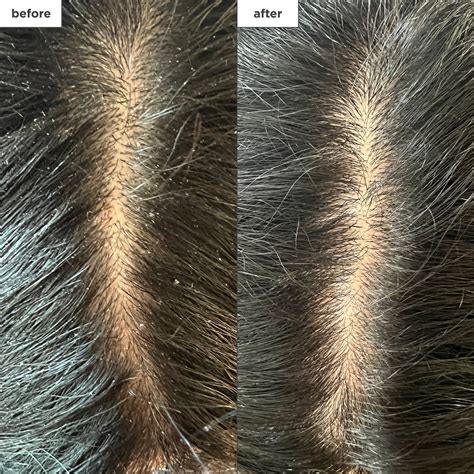 Scalp Dandruff 的图像结果