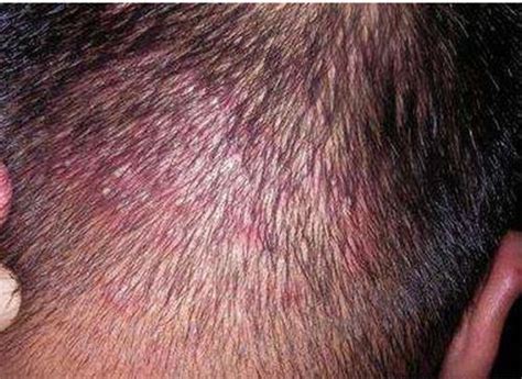 頭皮毛囊炎越發嚴重，長疙瘩還流血，做好3件事，一去不返 - 每日頭條