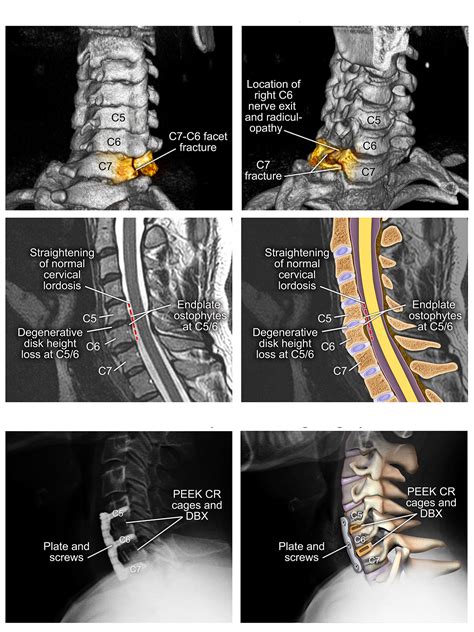 Neck Disc Fracture at Fernando Ward blog