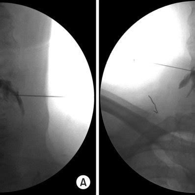 Image result for C8 Selective Nerve Root Block