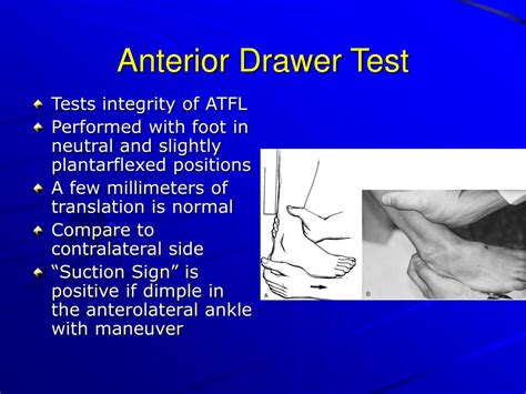 PPT - Everything You Ever Wanted to Know About Ankle Sprains PowerPoint ...