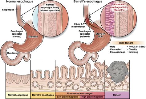 Barrett's esophagus - AGA GI Patient Center