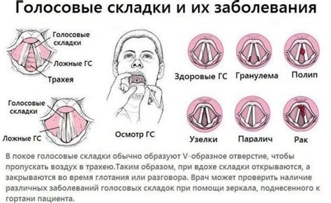 Парез (паралич) гортани: лечение | fr-dc.ru