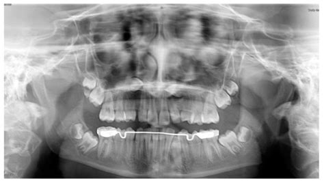 Uprighting Impacted Mandibular Second Molar Using a Skeletal Anchorage ...