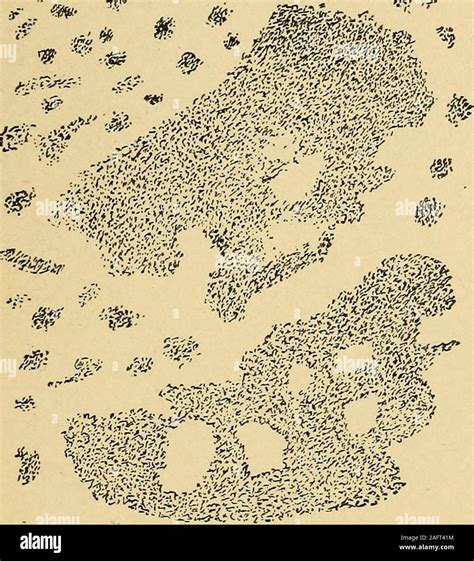 Sodium urate crystals hi-res stock photography and images - Alamy