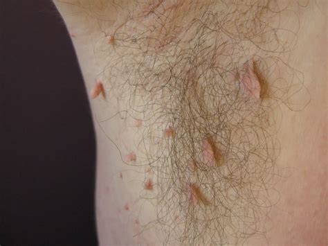 Skin Tag: Causes, Symptoms, and Treatment Options
