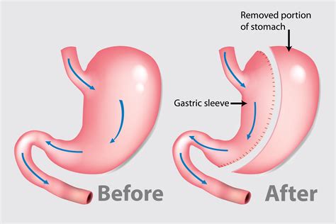Bariatric Surgery