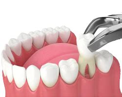 Tooth Extraction - Shine N Smile Dental