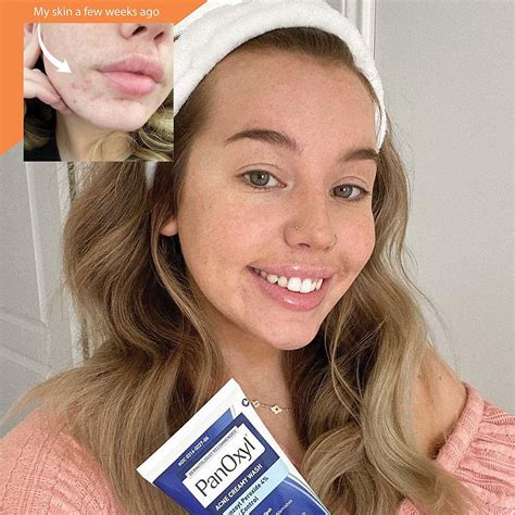 Panoxyl Acne Wash 4% Bundle with PM Patches - Complete Acne Treatment ...