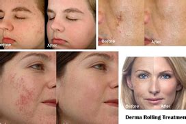 Best LED Light Therapy at Desire Clinic in Mumbai.