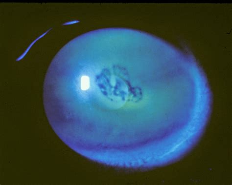 The Patient's Guide to Recurrent Corneal Erosion - Eyedolatry