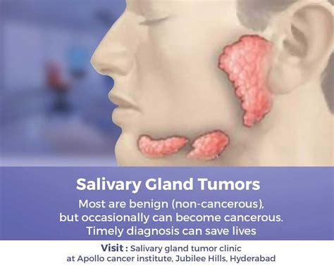 Parotid Surgery in India | Salivary Glands | Dr. Umanath Nayak