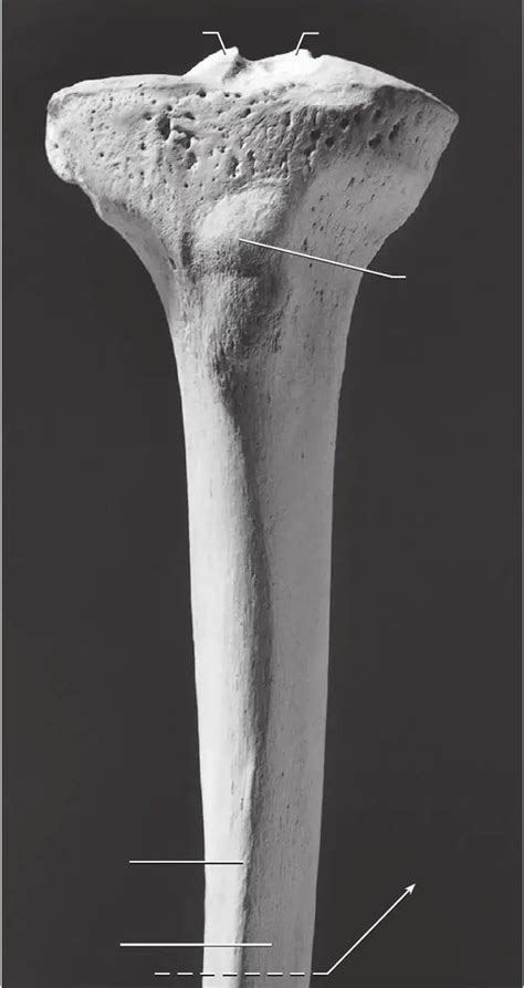 Proximal Tibia 的图像结果
