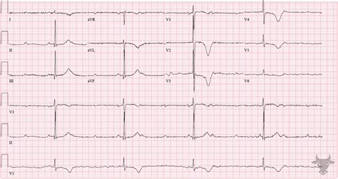 Second Degree Atrioventricular Block – Mobitz II | ECG Stampede