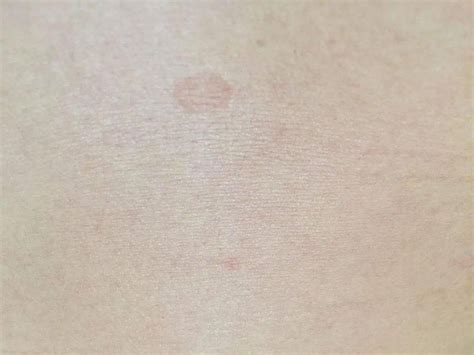 一到夏天前胸后背腋窝出现褐色圆形斑，是啥？会不会传染？_汗斑