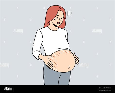 Tired pregnant woman with huge belly with stretch marks on last months ...