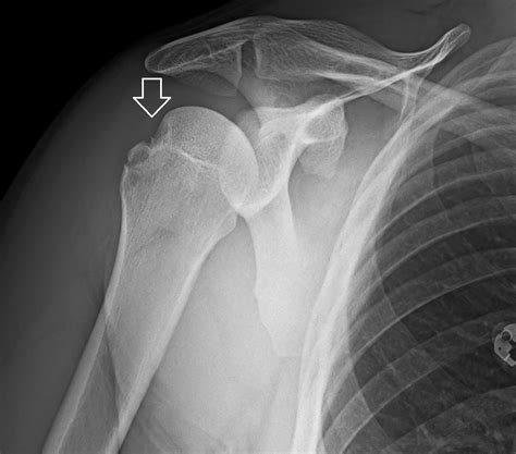 X Ray Shoulder Dislocation