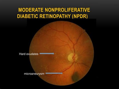 PPT - DIABETIC RETINOPATHY PowerPoint Presentation, free download - ID ...