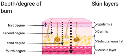 Fourth Degree Burn Diagram