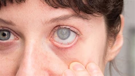 Cataract Surgery And Diabetes: Tips People With Diabetes Must Follow ...