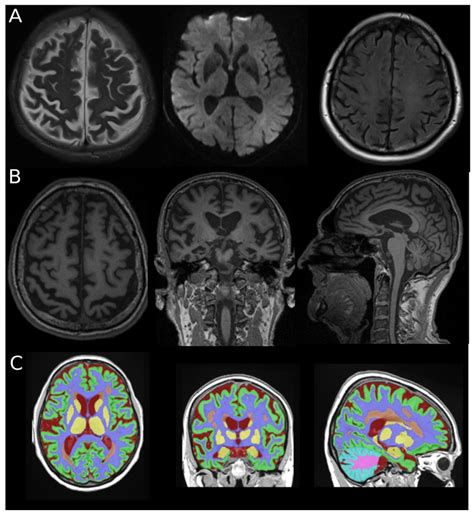 Frontal Lobe and Subregional Volumetric Alterations Across Alzheimer’s ...